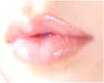 lip augmentation guide