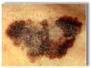 melanoma pictures