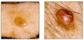 Skin cancer pictures & information
