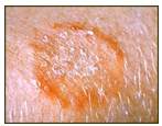 Ringworm rash