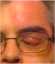 shingles rash