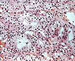 clear cell renal carcinoma