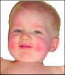 Fifth disease rash