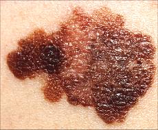typical black, brown & tan melanoma