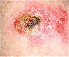 scaly dark melanoma