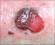 nodular melanoma