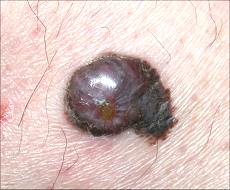 nodular melanoma