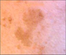 Melasma skin condition in pregnancy