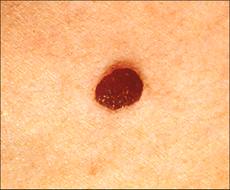 Normal mole