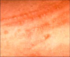 Poison ivy rash